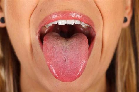 Pictures Of Early Signs Of Tongue Cancer - Infoupdate.org