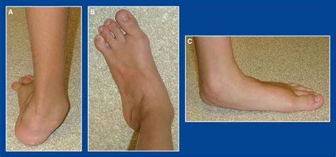 HINDFOOT - FOOT MALFORMATIONS - Principles and Management of Pediatric ...