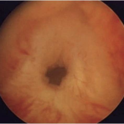 (PDF) Bladder neck contracture–incidence and management following ...