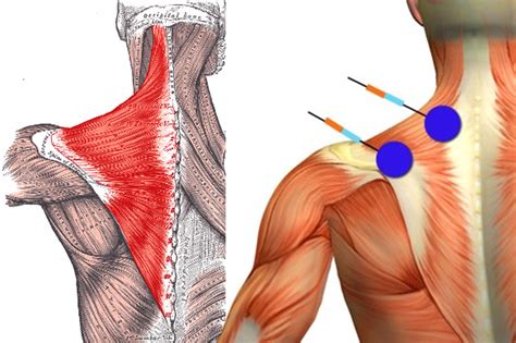 Trapezitis | Trapezius | Physiotherapeutic | Therapy | Wet Heat ...