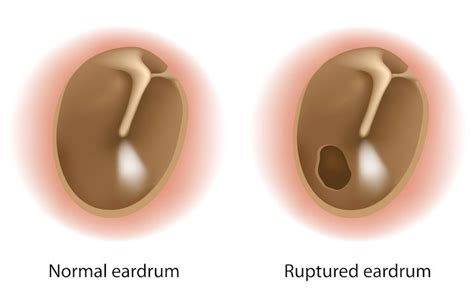 Infected Ear Drum