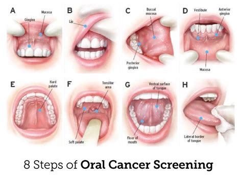 Oral Cancer Screening Surrey | Just Smiles Dental Clinic Surrey BC