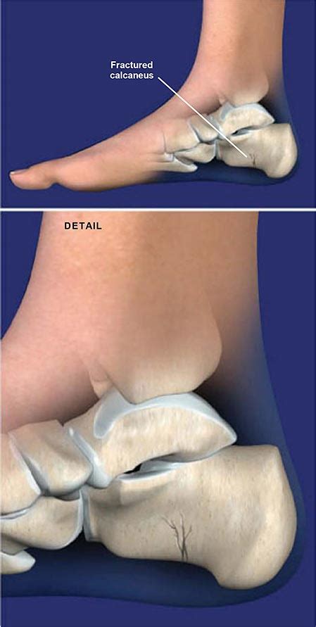 Fracture of the Heel Bone (Calcaneus) | Central Coast Orthopedic ...