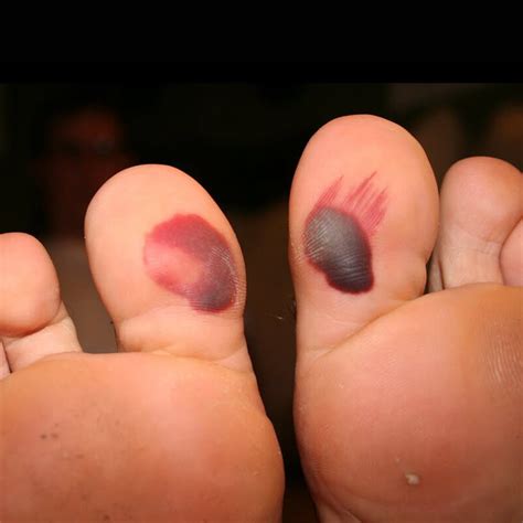 Blood Blister On Foot - Do's and Don'ts - Blister Prevention