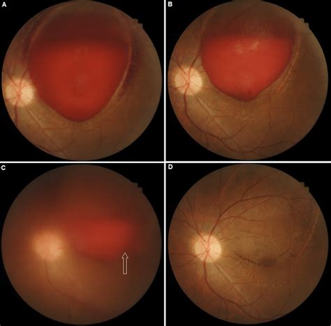 Treatment of Valsalva Retinopathy : Optometry and Vision Science