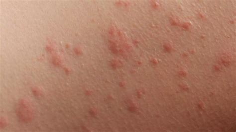 7 common summer skin rashes in children | Virtuwell