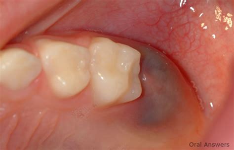 Eruption Cyst: Photos of a Purple Bump on the Gums | Oral Answers