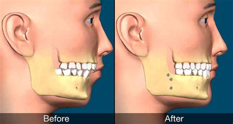 Jaw Straightening Surgery Options - Ascent Family Dental