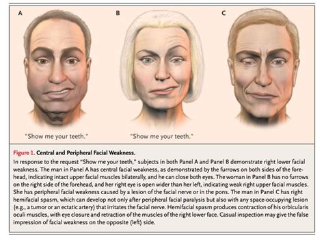 Cranial Nerve Lesion - IM Reference | Cranial nerves, Facial nerve ...