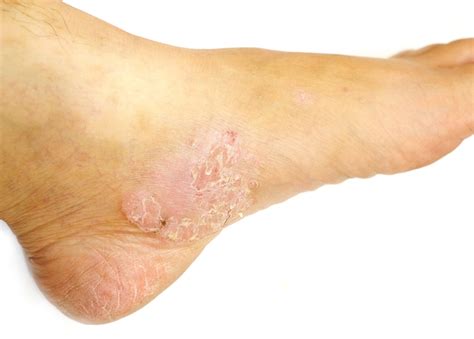 Skin Rash On Ankle