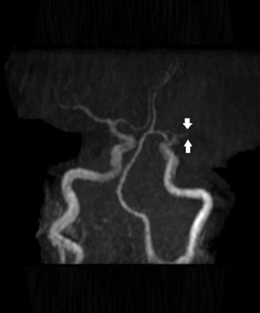 A case of large right MCA stroke with hyperdense MCA sign in CT imaging ...