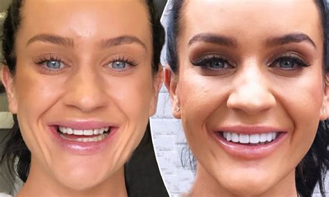 Celebrities With Veneers Before And After