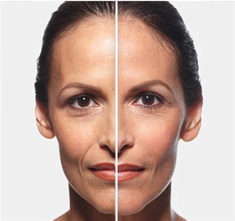 The Best Filler to Get Rid of Marionette Lines | The Skin Clinic Scottsdale