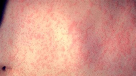 What Does Rubeola (Measles) Look Like?