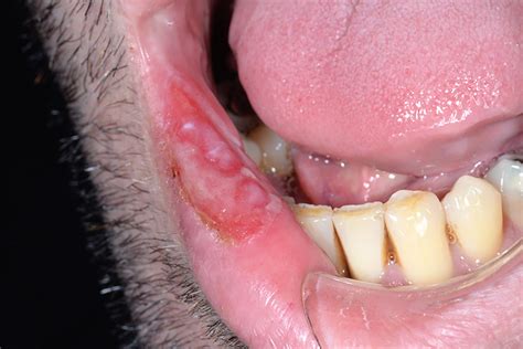 Oral syphilis – A case report - Scottish Dental magazine : Scottish ...