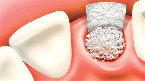 OC Maxillofacial Surgery: Dental Bone Grafts - What They Are and Why We ...