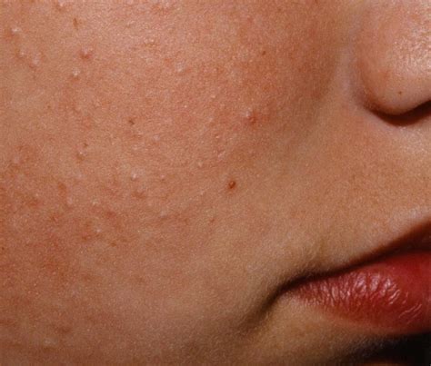 Gluten And Keratosis Pilaris AKA Chicken Skin Rash - Amy Burkhart, MD, RD