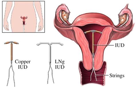 Your Guide to Non-Hormonal Birth Control Part 1: The Copper IUD ...