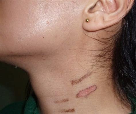 Laser hair removal side effects | How to avoid complications and Risks