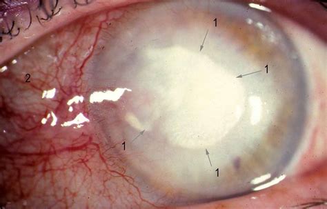 Necrotizing Interstitial Keratitis