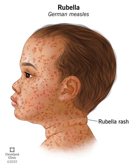 Rubella (German Measles): Symptoms, Treatment & Prevention