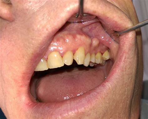 Buccal exostosis - Wikiwand