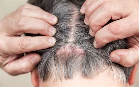 Scabs on Scalp: Causes, Diagnosis, and Treatment