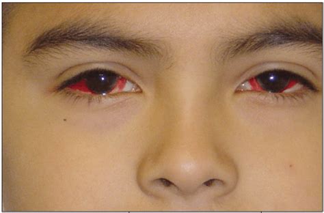 Traumatic Subconjunctival Hemorrhage|Causes, Symptoms And Treatment