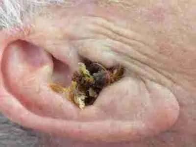 Microsuction Ear Wax Removal Lancing & Sompting - Ear Harmony