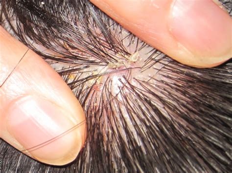 Mild Scalp Psoriasis Symptoms