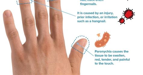 Paronychia Drainage