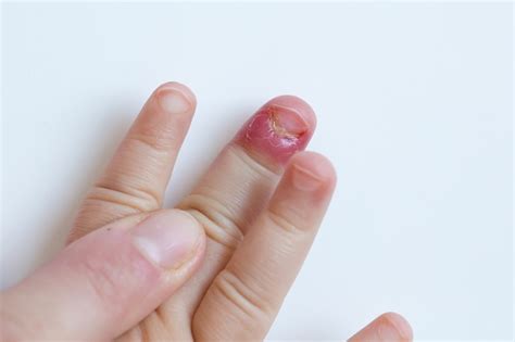 Infection Around Fingernail Cuticle - Awesome Nail