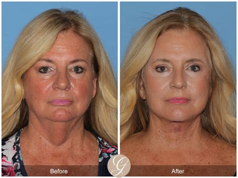 The Difference Between Deep Plane Facelift and SMAS Facelift | Sadati, MD