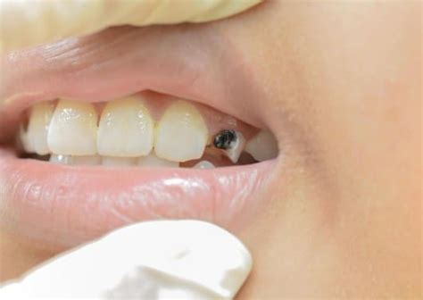 What is the broken tooth extraction procedure like? – Somos Dental