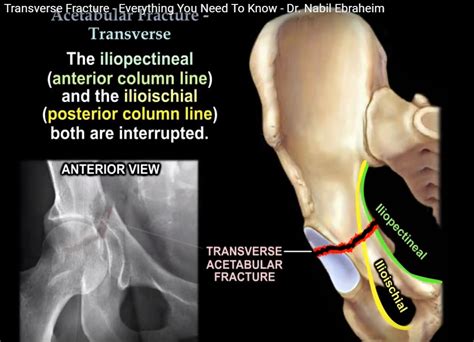 Transverse fractures of the Acetabulum — OrthopaedicPrinciples.com