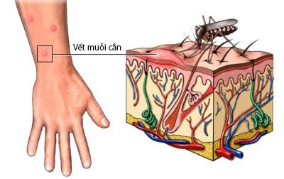 Bệnh Sốt xuất huyết DENGUE - Bệnh Viện FV