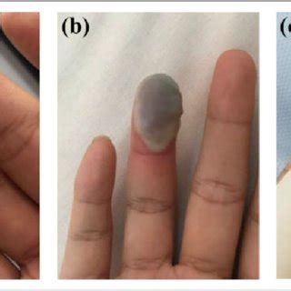 Dorsal appearance of right ring finger tip on day 1(a), day 2 (b) and ...