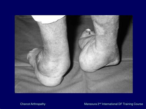 PPT - Charcot Arthropathy . PowerPoint Presentation, free download - ID ...