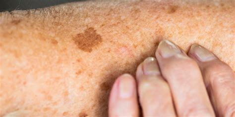 Skin Sunspots (Aka Age Spots): Causes, Prevention, and How to Get Rid ...