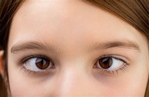 Can Vision Therapy Cure Strabismus? | Specialty Eye