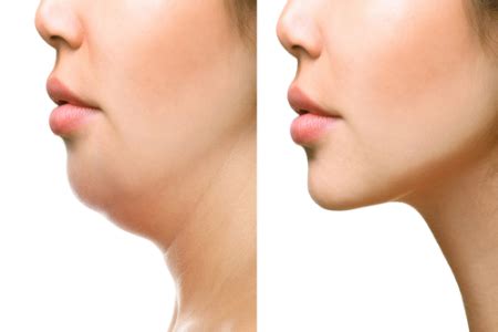 Meso Lipo (for Double Chin) – Subodha Skin Clinic