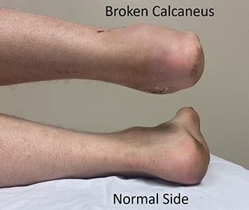 Life After A Calcaneus Fracture Surgery | earth-base