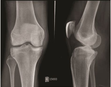 Lateral Tibial Plateau Bone Marrow Edema