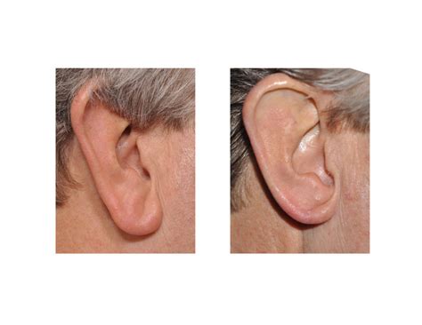 New Technique in Earlobe Reduction Surgery - Explore Plastic Surgery