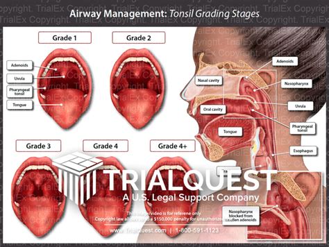 Airway Management: Tonsil Grading Stages - TrialExhibits Inc.