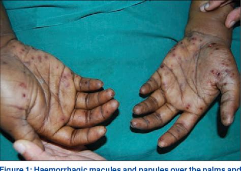 Figure 3 from Janeway lesions - revisited. | Semantic Scholar