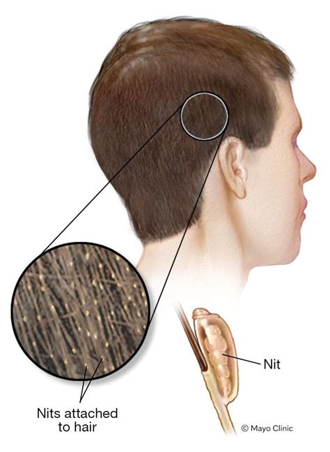 Head Lice Nits Vs Eggs