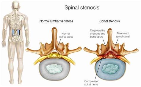 Back surgery, lower back surgery, indications, types, risks & complications