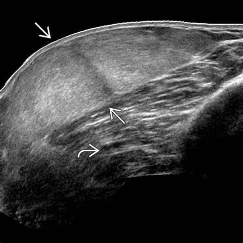 Lipoma | Radiology Key