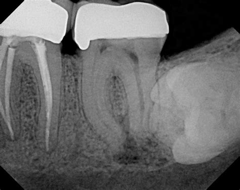 The Endo Blog: Persistent Post-Treatment (Apical) Periodontitis.